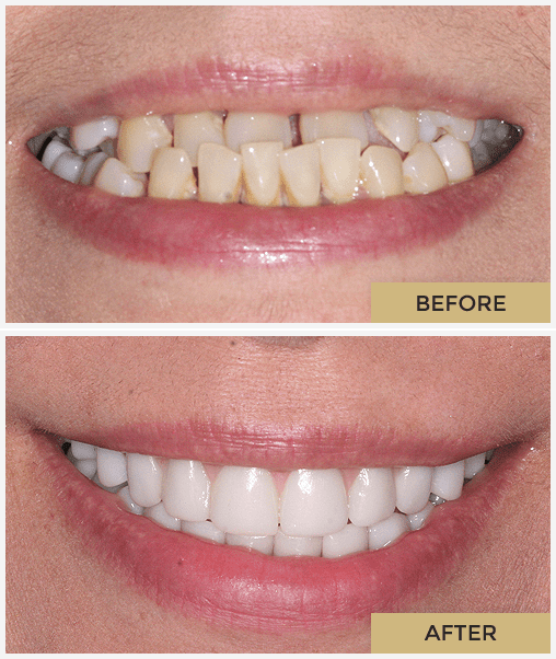 Dental Treatment Before & After Photos - Unfiltered Results