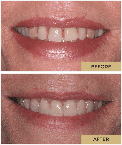 Before and after with Invisalign - dentist in Scottsdale, AZ