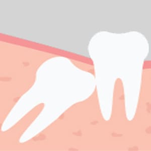 Illustration of impacted tooth