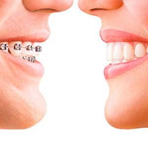 Comparing Invisalign and braces