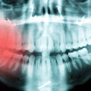 X-rays of impacted wisdom teeth