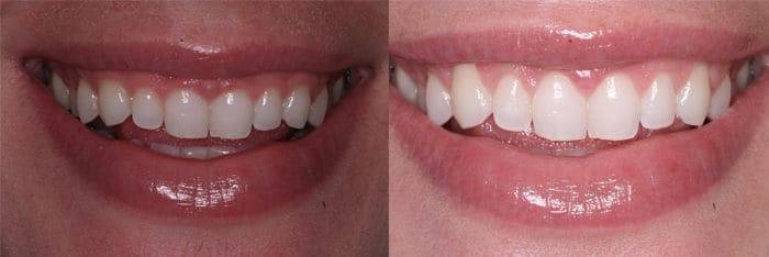 Before and after - dentist in Scottsdale, AZ