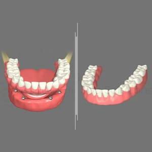 Dentures vs. dental implants illustration