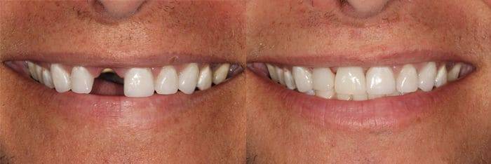 Before and after - dentist in Scottsdale, AZ