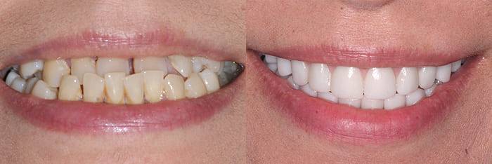 Before and after - dentist in Scottsdale, AZ