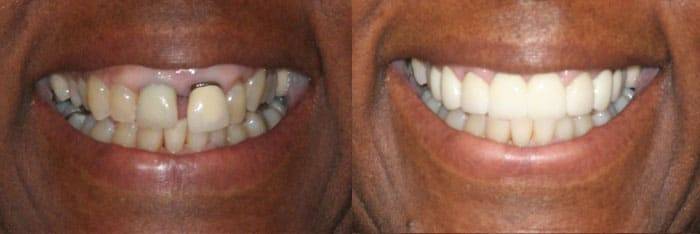 Before and after - dentist in Scottsdale, AZ