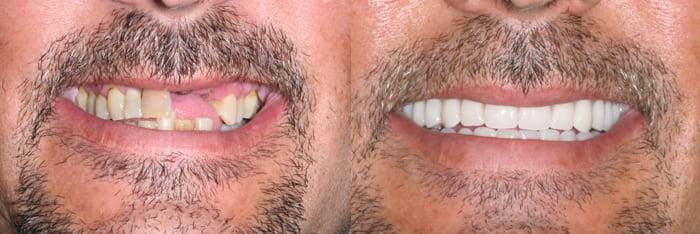 Before and after - dentist in Scottsdale, AZ