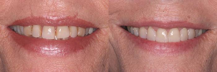 Before and after - dentist in Scottsdale, AZ