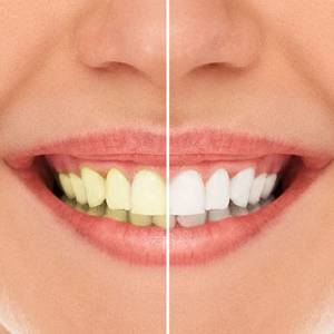 Before and after teeth whitening - dentist in Scottsdale, AZ