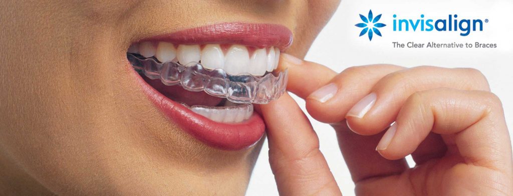 Invisalign in Scottsdale AZ