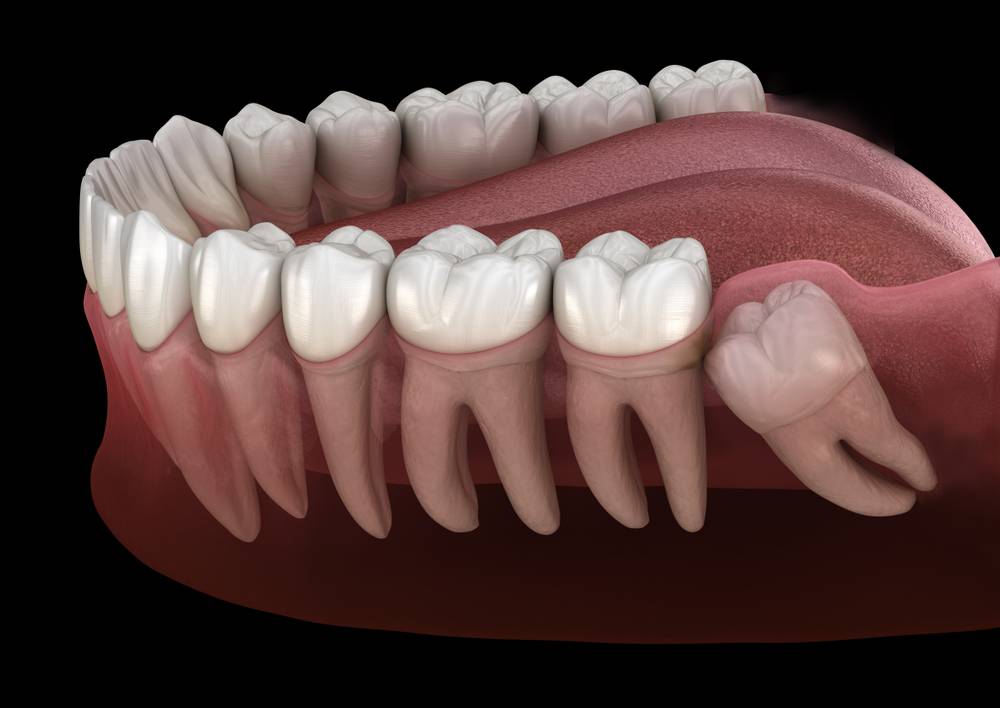 wisdom teeth removal - dentist in Scottsdale, AZ